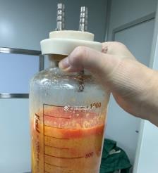 固原水动力吸脂手术要做多久？